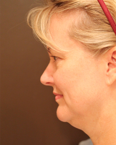 facelift patient