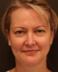 facelift patient