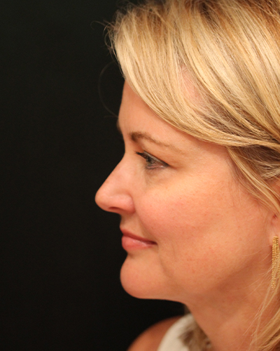 facelift patient