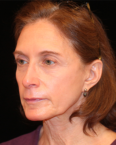 facelift patient