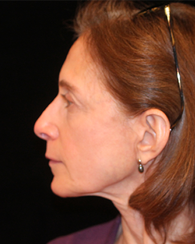 facelift patient