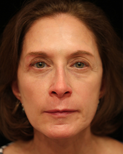 facelift patient