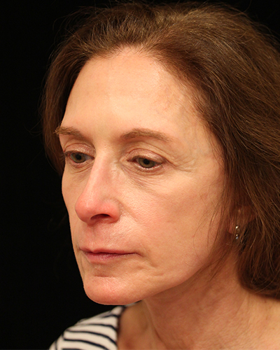 facelift patient