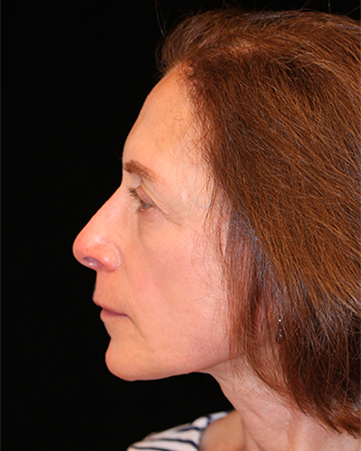 facelift patient