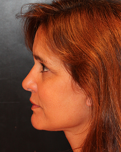 facelift patient