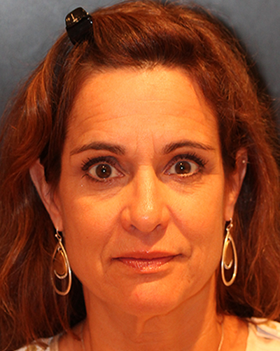 facelift patient