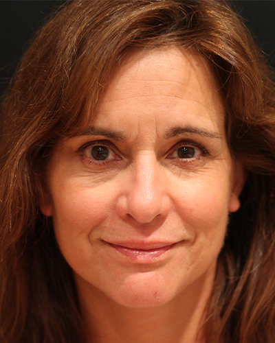 facelift patient