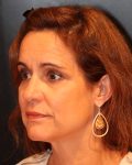 facelift patient