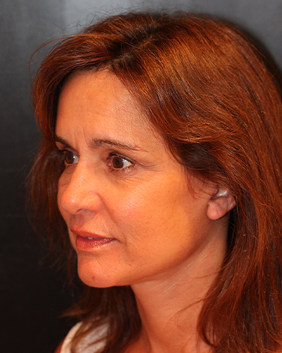 facelift patient