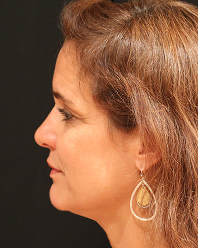 facelift patient