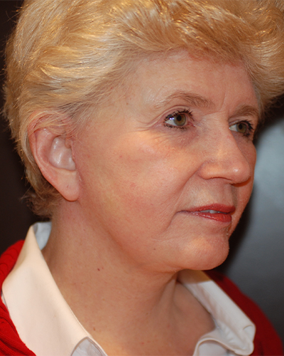 facelift patient