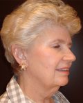 facelift patient