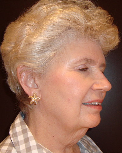facelift patient