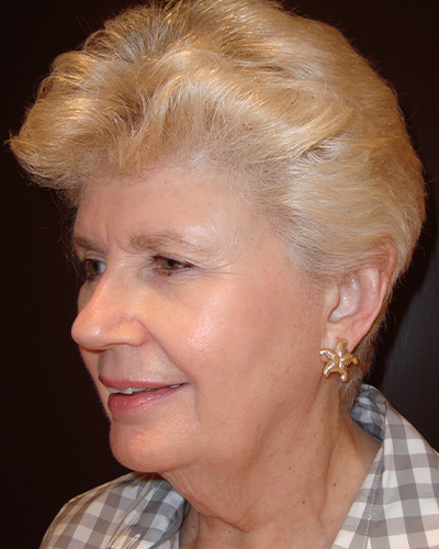 facelift patient