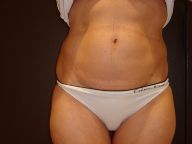 liposuction patient