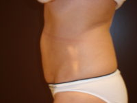 liposuction patient