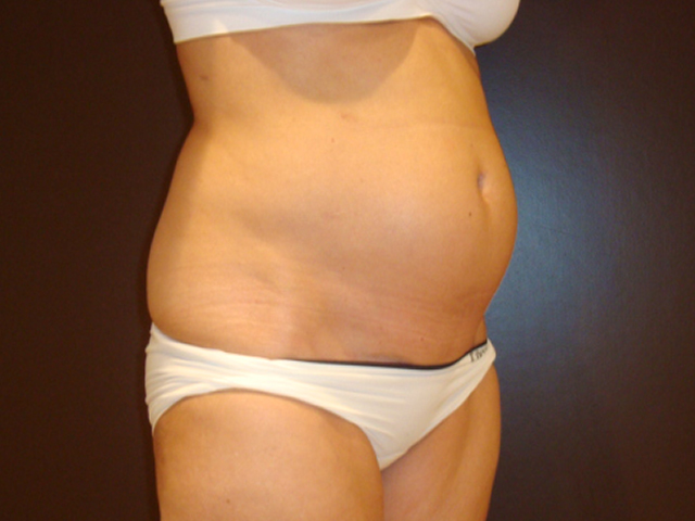 liposuction patient