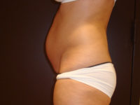 liposuction patient