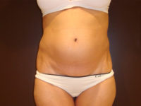 liposuction patient