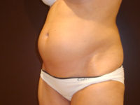 liposuction patient