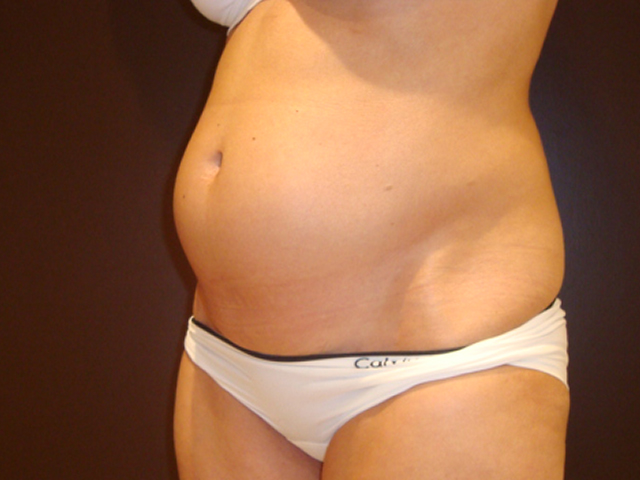 liposuction patient