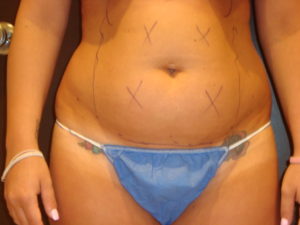 liposuction patient