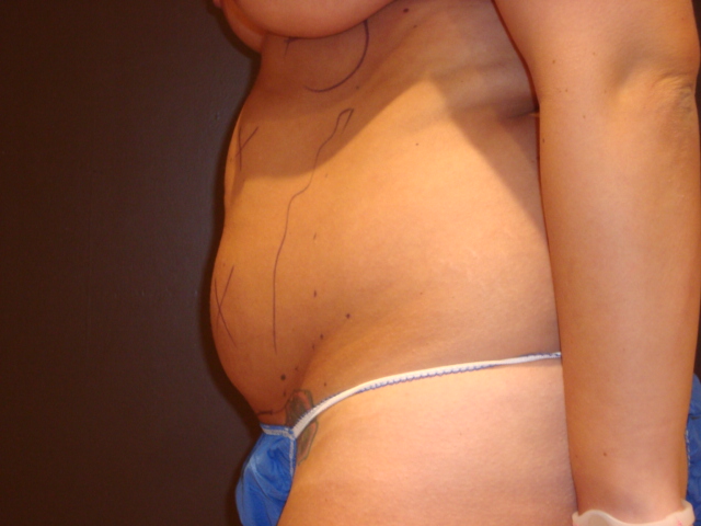 liposuction patient