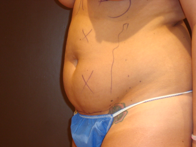 liposuction patient
