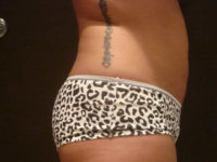 liposuction patient