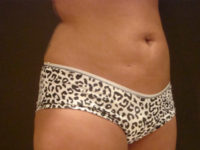 liposuction patient