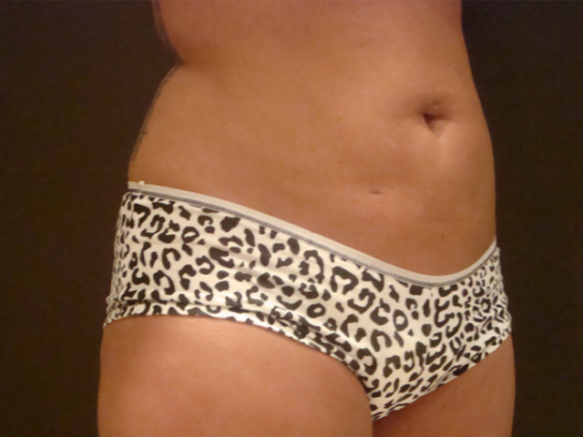 liposuction patient