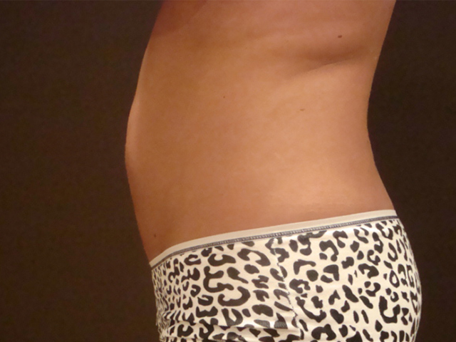 liposuction patient