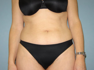 liposuction patient