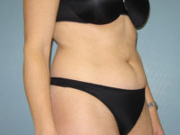 liposuction patient