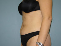 liposuction patient