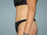 liposuction patient