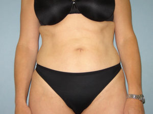 liposuction patient