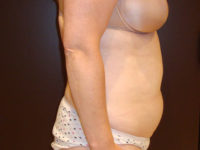 liposuction patient