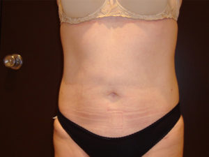 liposuction patient