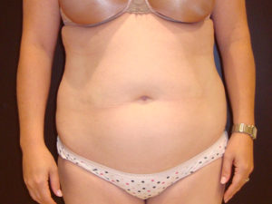 liposuction patient