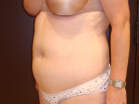 liposuction patient