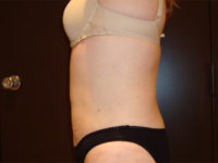 liposuction patient
