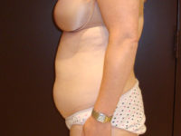 liposuction patient
