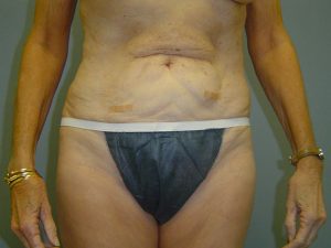 liposuction patient