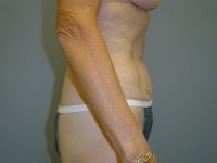 liposuction patient