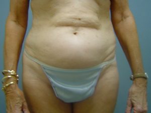 liposuction patient