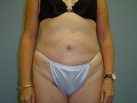 liposuction patient