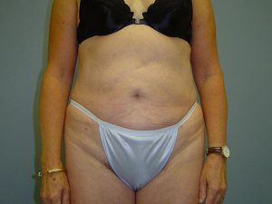 liposuction patient