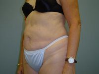 liposuction patient