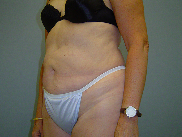 liposuction patient